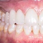 Дефекты краевого прилегания зубных протезов