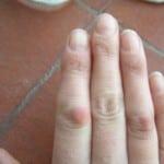 Деформация суставов пальцев рук: лечение искривления Деформация суставов пальцев рук причины